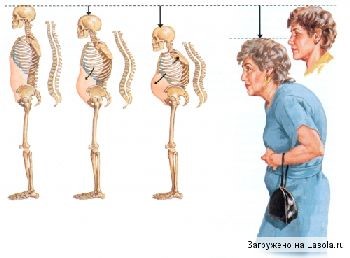 osteoporoz11072021 1